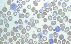 Abnormal megakaryocytes
Abnormal platelets!
