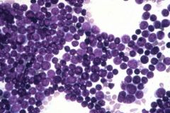 Monotonous bone marrow biopsies and smears: all blasts!

Blasts:
-Larger
-Irregular
-Chromatin in the nuclei that you can see well