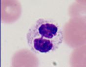 Pelger-Huet neutrophils; neutrophils whose nuclei are hyposegmeneted