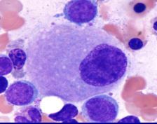 Multiple separate nuclei
Unilobate megakaryocytes (instead of many-lobed)
Small platelets