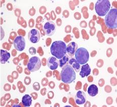 1. Leukocytosis with a left shift
2. Normocytic anemia
3. Thrombocytopenia in 50% of pts
4. Absolute eosinophilia
5. Absolute increase in basophils