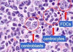 Small cells

Small cells with clefts: centrocytes
Hollowed out nuclei with multiple nucleoli: centroblasts (grading)
Dispersed chromatin with a central nucleoli: FDC (follicular dendritic cells)