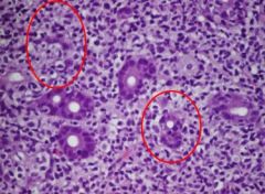 Lymphoepithelial lesions: the lymphocytes are invading the epithelium!