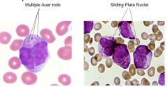 Multiple auer rods
Sliding plate nuclei

Or, promyelocytes