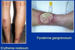 Pyoderma gangrenosum
Erythema nodosum

They happen when the whole colon is involved, often.