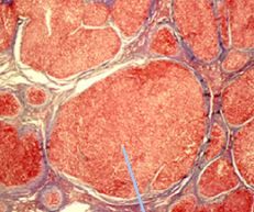 Regenerative nodules surrounded by fibrous tissue
