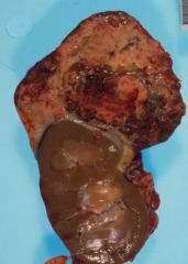 Large
Invasive
Necrotic
Invades the kidney