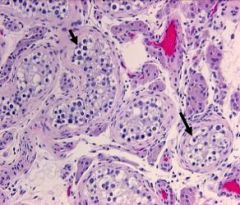 Malignant PREINVASIVE form of germ cell neoplasm

Confined to the seminiferous tubules