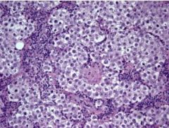 Nests of cells
Clear cytoplasm
Hyperchromatic nuclei
Fibrous septae infiltrated with lymphocytes

NO NUCLEAR CROWDING!