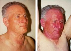 Facial flushing, increased stridor when the patient raises both arms above his/her head 

Happens due to thoracic inlet obstruction to a retrosternal goiter