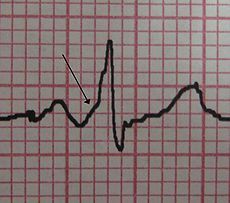 Woff Parkinson white syndrome

-0.1-0.3% population has --> sudden death
-asymptomatic
-can be dizzy, SOB, syncope
-delta wave! (see ECG)
-bundle of kent