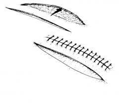 Simple bipedicle flap