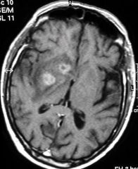 - usually a reactivation of a latent infection with Toxoplasmosis gondii
- symptoms both of a mass lesion (discrete deficits, headache) and of encephalitis (fever, altered mental status)
- CT scan or MRI shows characteristics findings: multiple ...