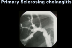 Primary sclerosing cholangitis:
 
Chronic cholestatic disease of the which bile ducts?
Most frequent in which sex?
80% have what associated condition? 
Any risk for malignancy?
How do you treat?
Does HIV cholangiopathy present a similar finding?