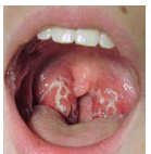 Streptococcal pharyngitis (sore throat):

Most common infection caused by__________