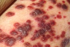1. Kaposi's sarcoma- more common in homosexual men than in other groups. Painless, raised brown-black or purple papules (common sites: face, chest, genitals and oral cavity). Widespread dissemination can occur
2. HSV infections, molluscum contagi...