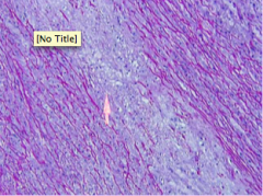 Name and describe the microscopic pathology indicated by arrow.