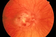 - common cause of serious opportunistic viral disease
- disseminated disease is common and usually involves the GI or pulmonary systems
- most important manifestation is retinitis- unilateral visual loss that can become bilateral if untreated (s...