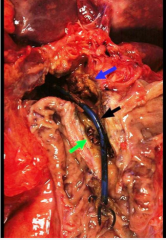 Extrahepatic cholangiocarcinoma. Identify what is indicated by the arrows.