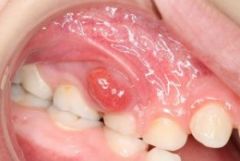 Gingival Abscesspuss-filled sac that forms at the gingival margin which is caused by bacteria entering the gums after injury.Symptoms-tenderness and swelling at gingival margins-exudate oozing -sensative to hot and cold in severe cases: nauseah...