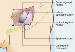 Indirect: Lateral to inferior epigastric artery

Direct: Medial to inferior epigastric artery