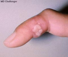 - HSV infection of the finger caused by inoculation into open skin surface. Common in health care workers.
- painful vesicular lesions erupt at the fingertip
- it may cause fever and axillary lymphadenopathy
- treat with acyclovir. Do NOT mista...
