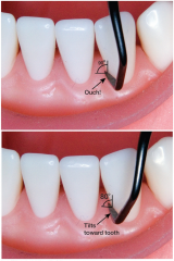 The face of the working-end is at a 90-degree angle to the lower shank
Positioning the lower shank parallel to the tooth surface creats an incorrect face-to-tooth angulation of 90-degrees.
Correct angulation is achieved by tilting the lower shank ...