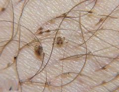 - pubic lice or "crabs" is a common STD caused by Phthirus pubis (the pubic or crab louse)
- It can be transmitted through sexual contact, clothing or towels
- Severe pruritus in the genital region is characteristic. Other hairy areas of the bod...