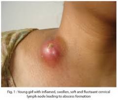 - this is inflmmation of a lymph node (single or multiple) usually caused by local skin or soft tissue bacterial infection often hemolytic streptococci and staphylococci)
- it presents with fever, tender lymphadenopthy of regional lymph nodes and...