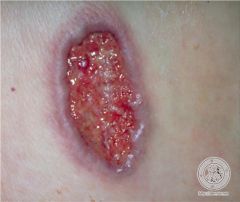 purulent ulcer with violaceous borders?