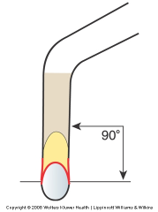 The face of a sickle scaler is perpendicular (90 degrees) to the lower shank.
The two cutting edges are level with one another.
