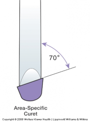 the lower edge is used to remove calculus and is called the working cutting edge
the higher edge is not used and is called the nonworking cutting edge