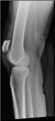 A 40-year-old recreational basketball player injured his knee while jumping for a rebound. He felt a pop and developed immediate swelling. His radiographs are shown in Figures A and B. What is the recommended management?  
1.  Obtain an MRI
2.  ...