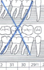 Adjacent missing teeth may be marked with a large X through the group
Edentulous arch is marked with one large X over entire arch