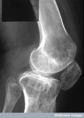 Figure B represents iatrogenic patella baja and an elevated joint line caused by excessive resection of the distal femur and contracture of the patellar tendon likely as a result of lateral patellar release. Figure A does not demonstrate pre-opera...