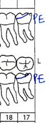 Partially erupted teeth are charted by drawing a blue line demonstrating gingival margin around crown and writing PE at the apex.
Partially erupted teeth - only part of tooth erupts through tissue due to mandible length