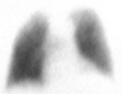 Name this lung view