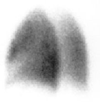 Name this lung view