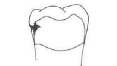 Interproximal (posterior)