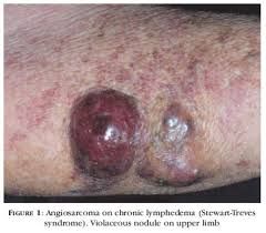 -axillary lymph node dissection (e.g., after mastectomy) is risk factor for developing chronic lymphedema of ipsilateral arm

-chronic lymphedema predisposes to the development of angiosarcoma (Stewart-Treves syndrome)