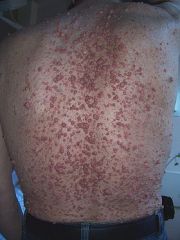 -neurofibromas are soft rubbery asymptomatic cutaneous nodules that commonly appear during second and third decades of life