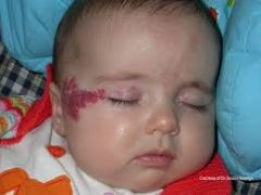 -hemangiomas are benign congenital vascular neoplasms that affect infants

-hemangiomas often enlarge in the months following birth before spontaneously involuting

-"cavernous hemangioma" = deep hemangioma