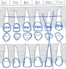 Abutments = All aspects of the crown are outlined in blue and indicated on buccal/facial surface of type (like crowns)
Pontics  = Charted same way but with a large blue X through all aspects of the tooth.
A line is drawn connecting the roots of ab...