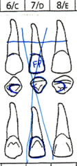 Pontic = All aspects of the crown are outlined in blue and indicated on buccal/facial surface of type (like crowns). Large blue X is drawn through all aspects of the tooth.
Abutments = Outline in blue on occlusal surface representing attachment
To...