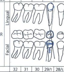 Crown is outlined in blue with material indicated on buccal suface
Virtical line with 3 horizontal lines are drawn in buccal root attached to crown
Tooth is marked with a large blue X through all aspects
Tooth number, type, date, and Dr are noted ...