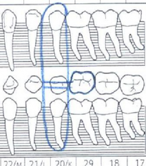 Occlusal aspect of banded tooth is outlined in blue
Unerupted tooth is circled in blue around all aspects of the tooth
two horizontal lines are drawn through the occlusal aspect within the circle.