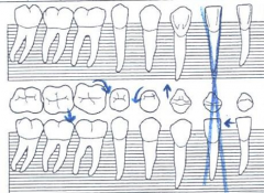 Blue arrows are drawn around occlusal/incisal aspects of the tooth indicating the directing the tooth is rotated/tipped/tilted/drifting
A comment can be made to further explain the position(s) if necessary.