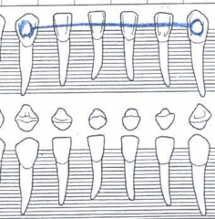 An outline of attachments are drawn on the lingual surface of attached teeth
A blue line is drawn across the lingual crowns of teeth from canine to canine.
May see a tiny wire bonded to the maxillary centeral incisors