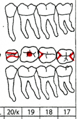 Charted in red.
Outlined if MOD
Triangle outline for mesial, distal, or both