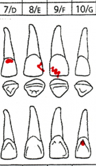 Charted in red.
Triangle outline indicates mesial, distal, or both
Dot on facial/lingual indicates facial/lingual only
Jagged line indicates a fracture.